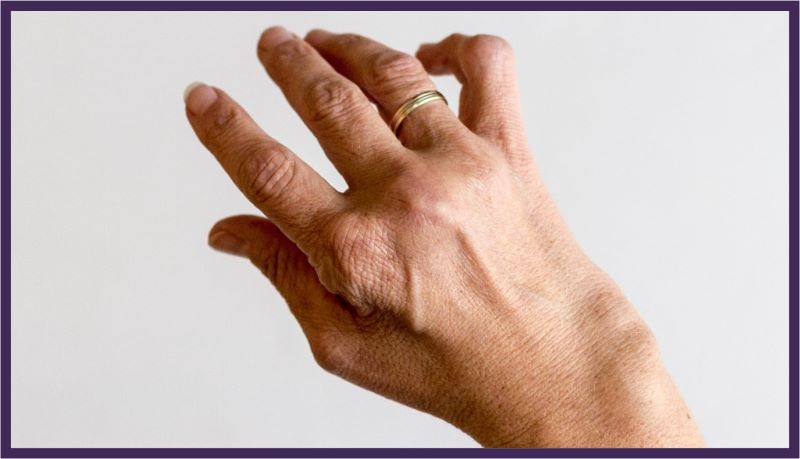 A person's hand showing how they're affected by arthritis